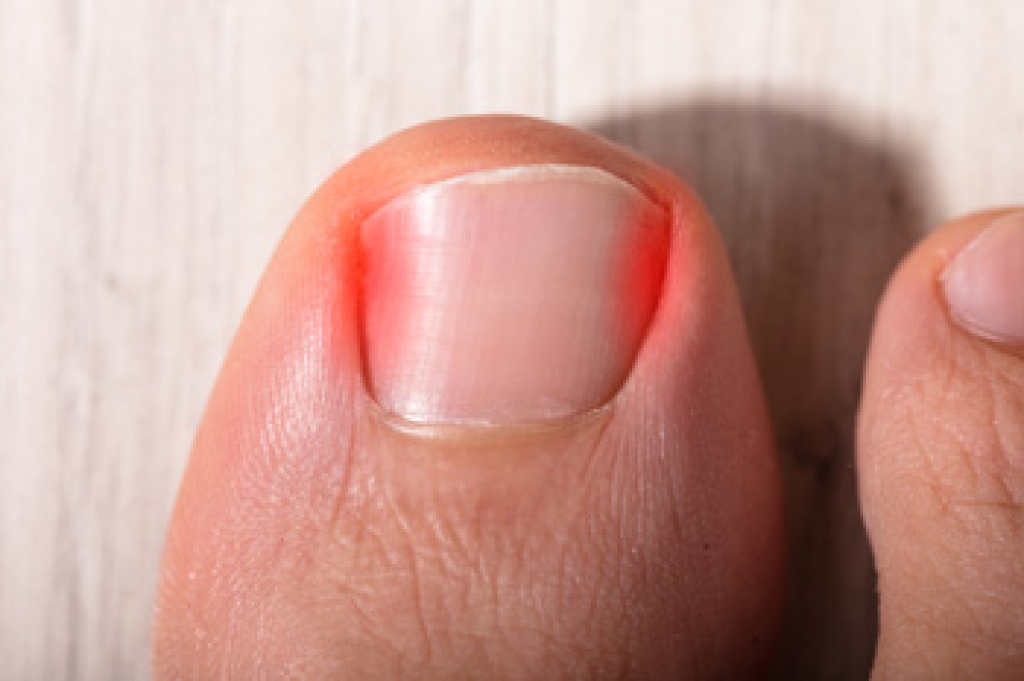 Understanding Skin Bridging and Ingrown Toenails