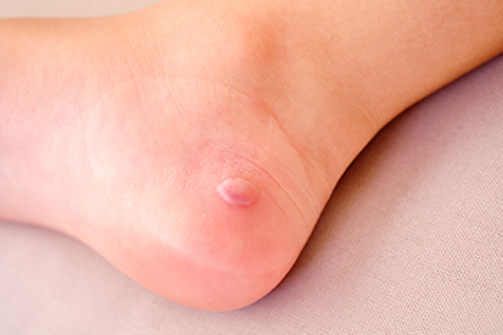 How a Podiatrist Treats Foot Blisters