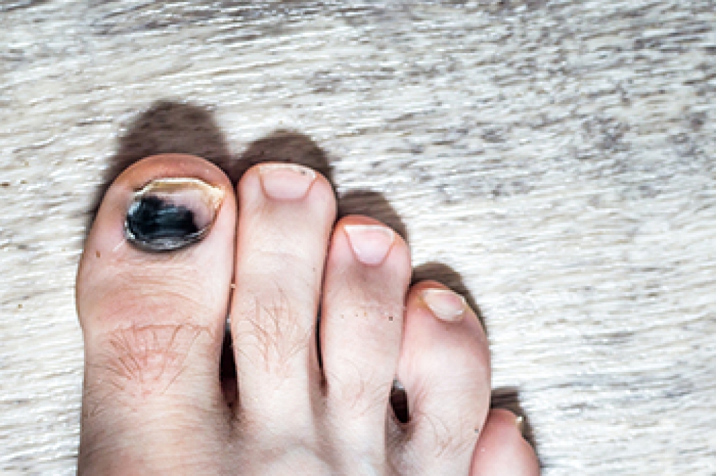 Causes of Bruised Toenails