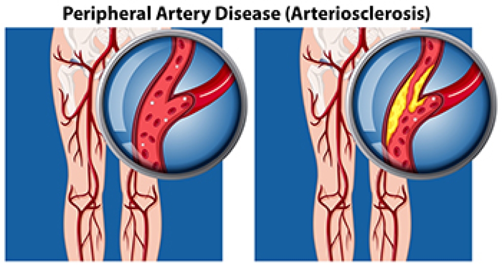Definition and Causes of PAD