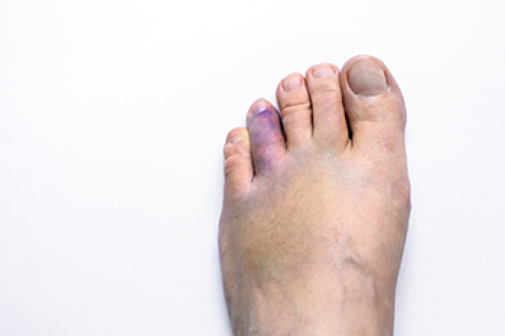 What Causes a Broken Toe?