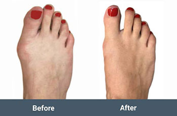 before and after mis bunion