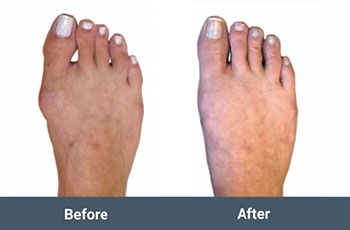 before and after mis bunion