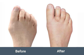 before and after mis bunion