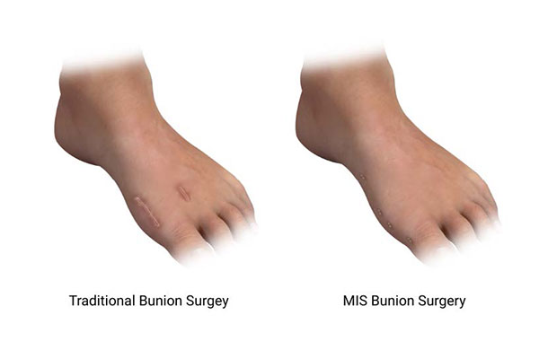 mis bunion