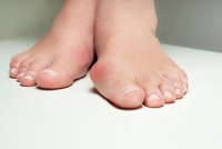 Definition and Causes of Bunions