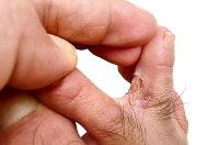 Athlete’s Foot May Be a Chronic Skin Infection