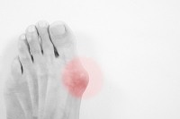 Relief From Bunions