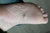 Risk Factors of Plantar Fibromatosis