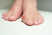 Causes and Possible Relief Treatments for Bunions