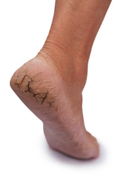 Cut on heel of foot outlet