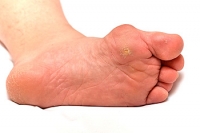 How to Tell If You’ve Developed Gout