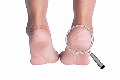 Pumice stone for cracked heels outlet