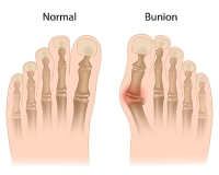 Common Deformities of the Feet